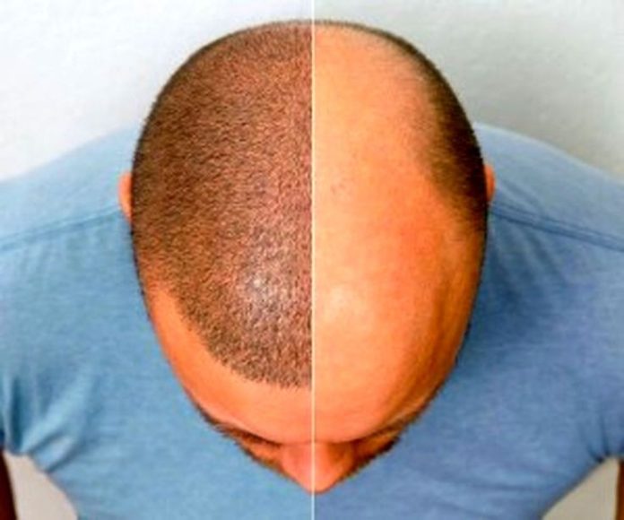 #hairtransplant