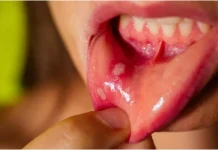 गर्मी में मुंह के छालों से हैं परेशान? अपनाएं ये 3 आसान घरेलू उपाय और पाएं तुरंत राहत
