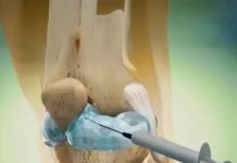 चीन के वैज्ञानिकों की क्रांतिकारी खोज: टूटी हड्डियों को 3 मिनट में जोड़ देगा ‘बोन ग्लू’