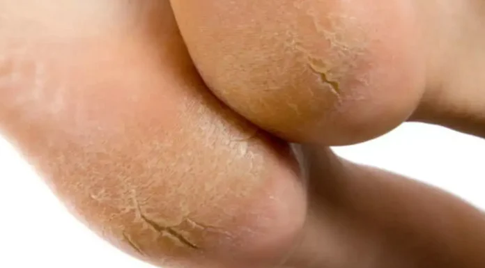 सर्दियों में फटी एड़ियों और रूखे होंठों से पाएं राहत, घर पर बनाएं नेचुरल मॉइश्चराइजिंग क्रीम