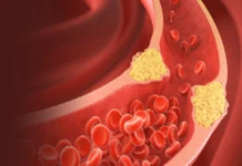 हाई कोलेस्ट्रॉल बना ‘साइलेंट किलर’, दिल की सेहत पर मंडरा रहा बड़ा खतरा